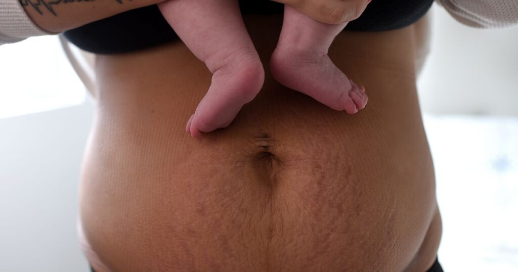 postpartum mother with stretch marks on her belly, holding her baby with feet visible