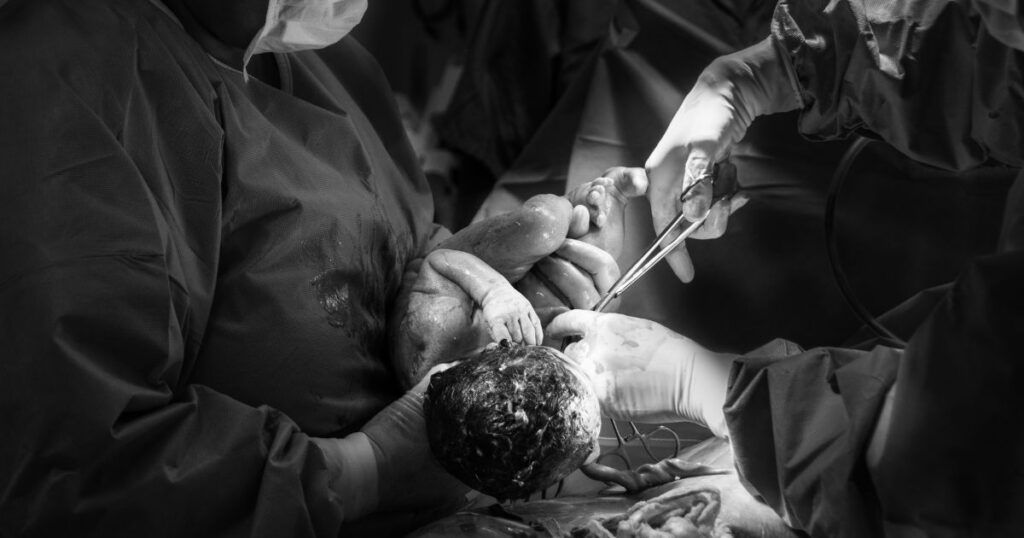 black and white photo of doctors cutting a newborn baby's umbilical cord after birth in a hospital